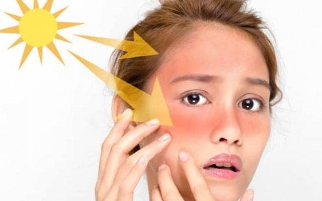 知っておきたい！日焼け後のケアでやるべきこと