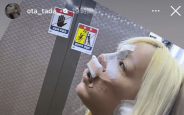 「抜糸して日本🇯🇵帰ります」夜ふかし📺多田さん、韓国🇰🇷リアル😵整形🏥レポ💦大反響