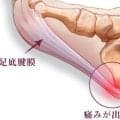 足底腱膜炎という症状をご存知ですか？