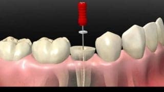 歯が灰色に！？歯が変色してしまう原因と解決策