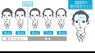 【衝撃】薄毛の境界線が変更に。おでこに指4本収まれば“薄毛”に認定！？