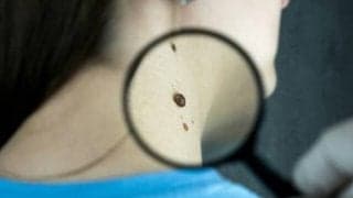 もう首イボは増やしたくない！薬剤師が教える食材と漢方による予防法